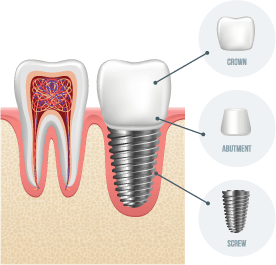 Dental-Implant United Dental Care