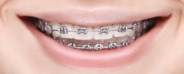 Metal Braces