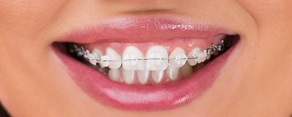 Tooth Coloured Braces