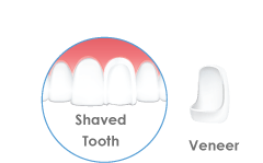 Veneers United Dental Clinic