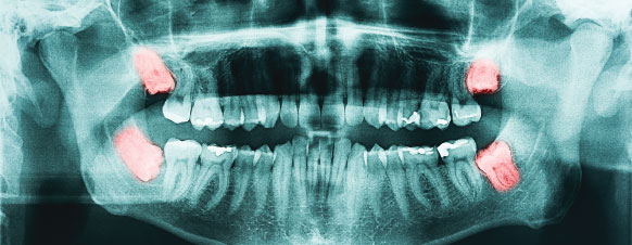 wisdom tooth xray highlighting teeth