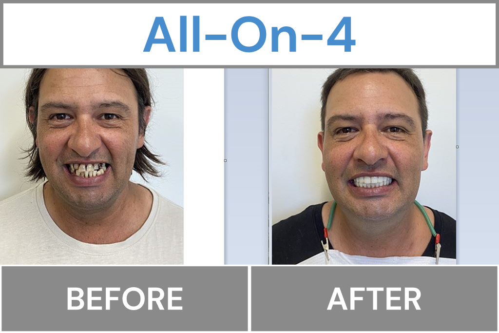 All-On-4
