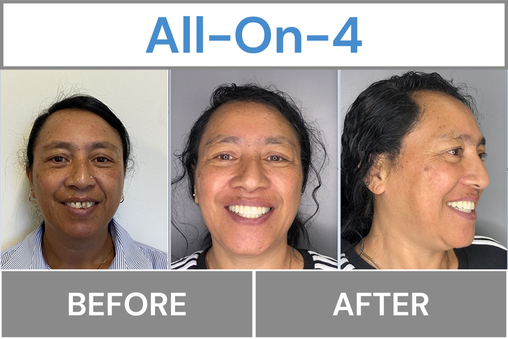 All-On-4