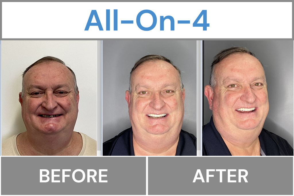 All-On-4