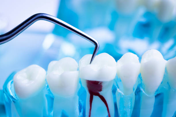 The Objective of Root Canal Treatment