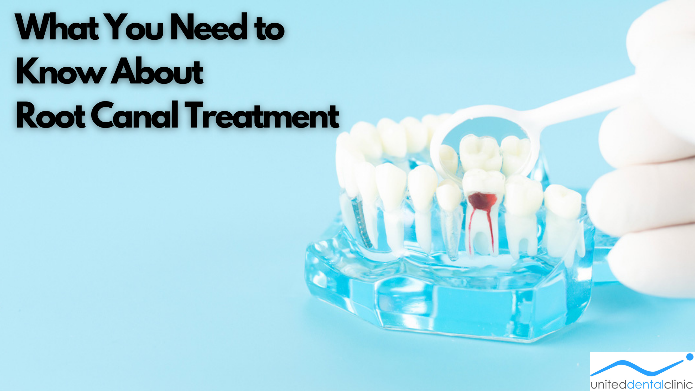 What You Need to Know About Root Canal Treatment?