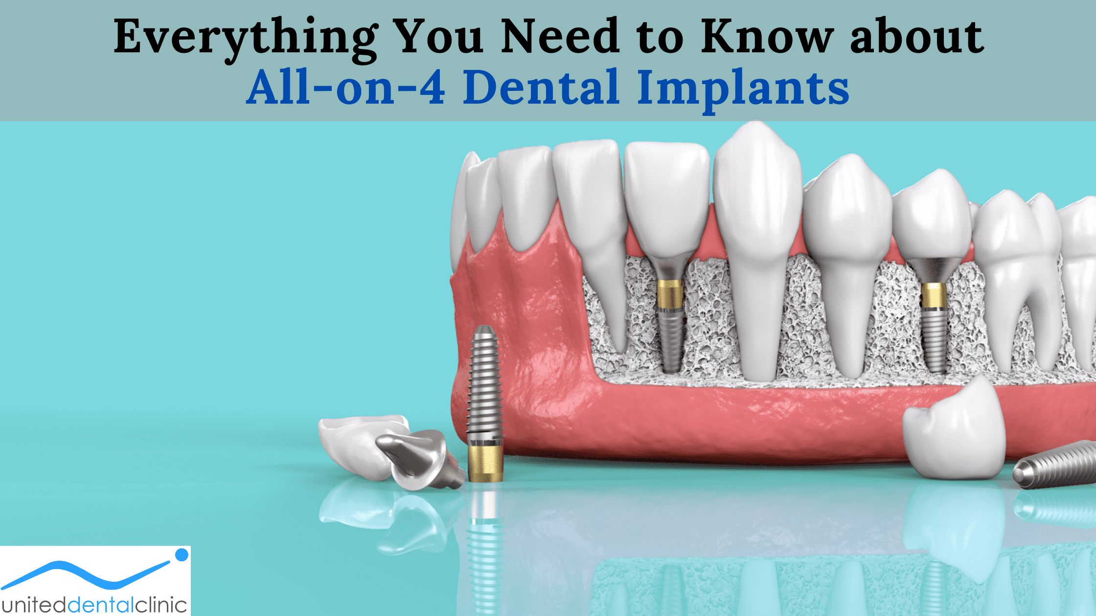 Everything You Need to Know about All-on-4 Dental Implants