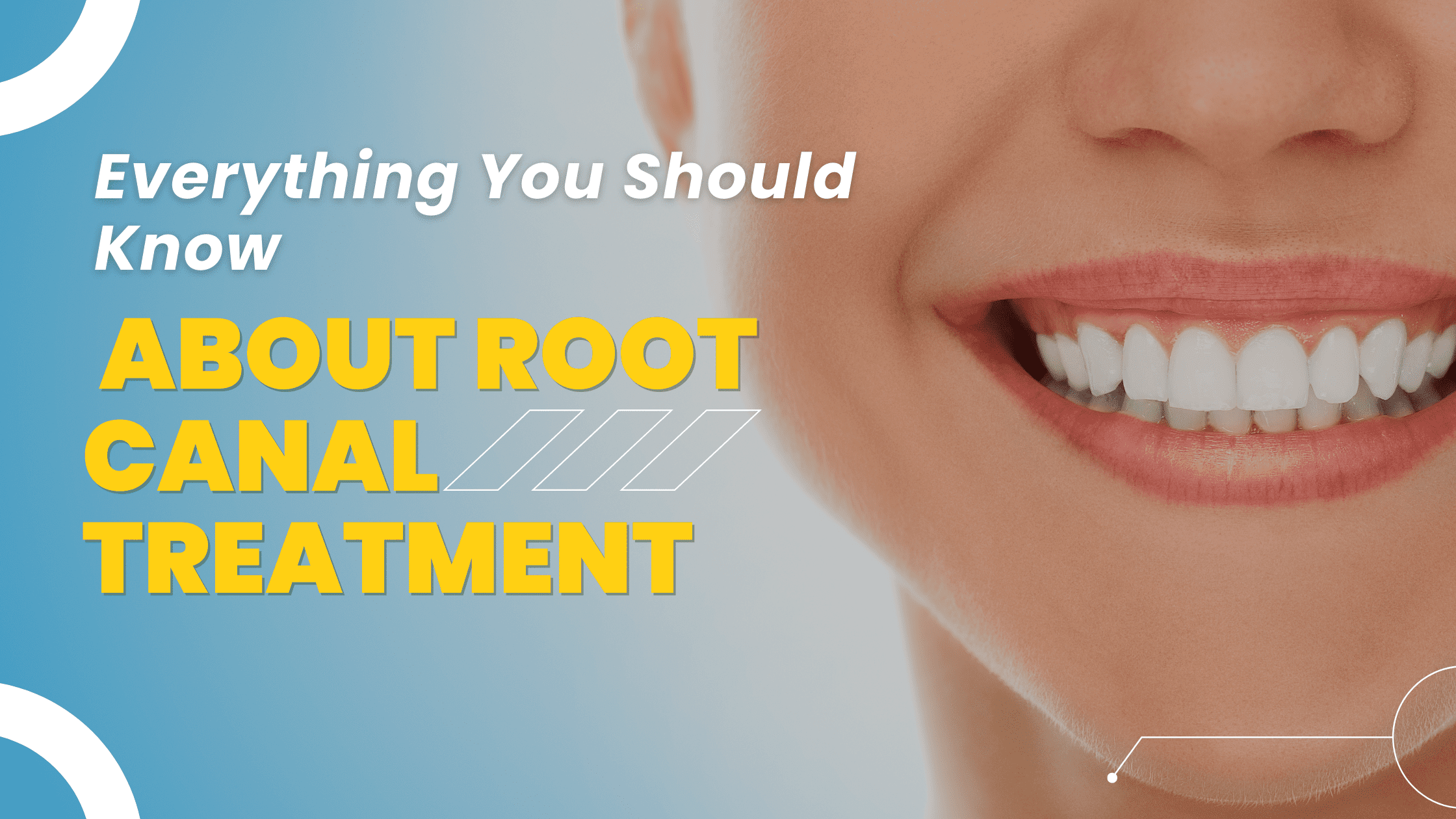 Everything You Should Know About Root Canal Treatment