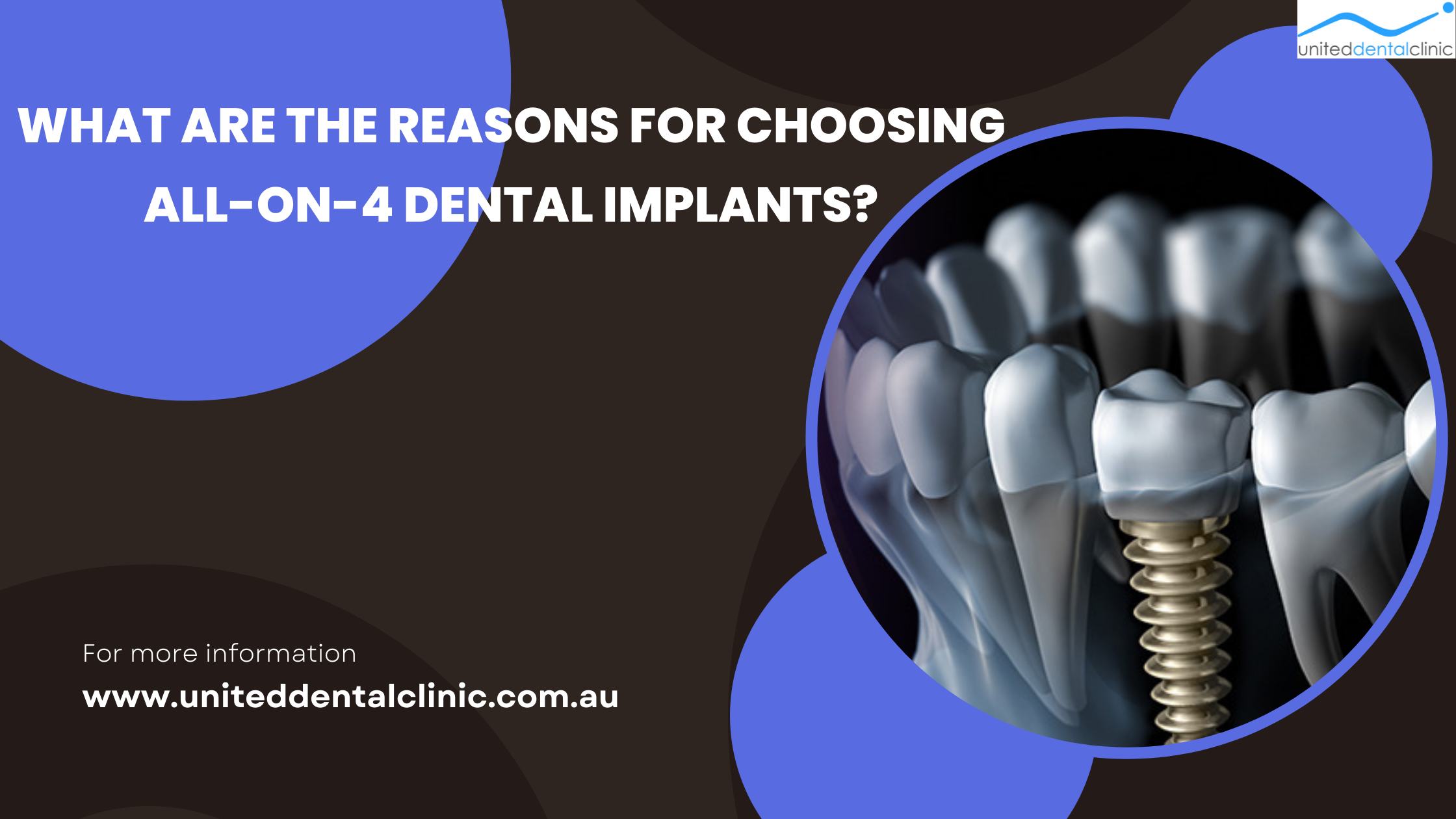 Reasons for Choosing All-On-4 Dental Implants