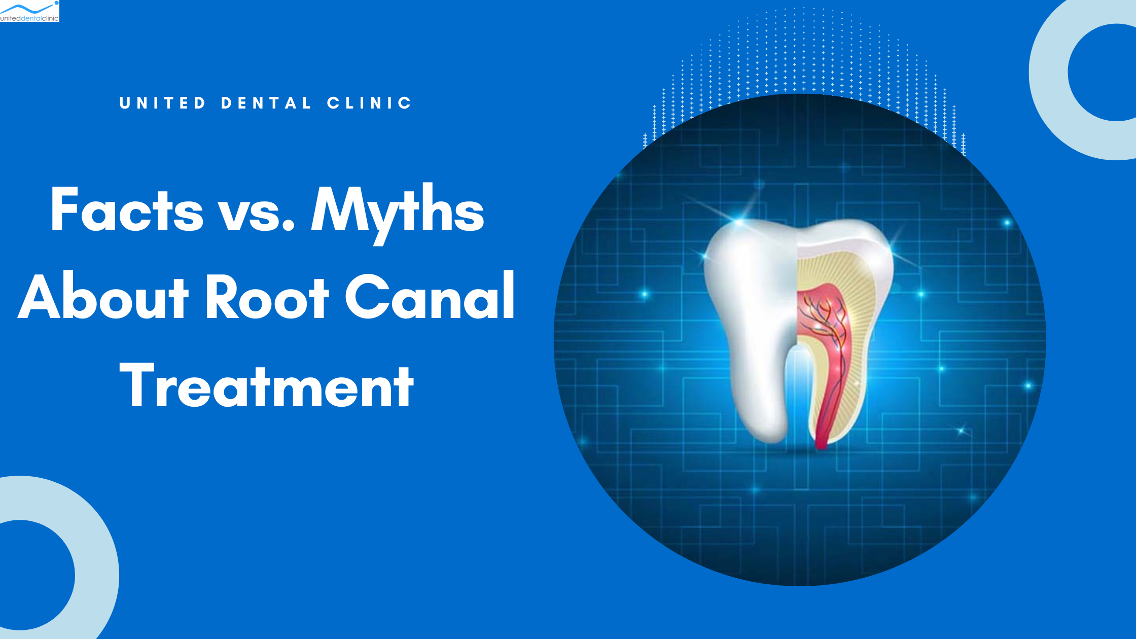 Facts vs. Myths About Root Canal Treatment