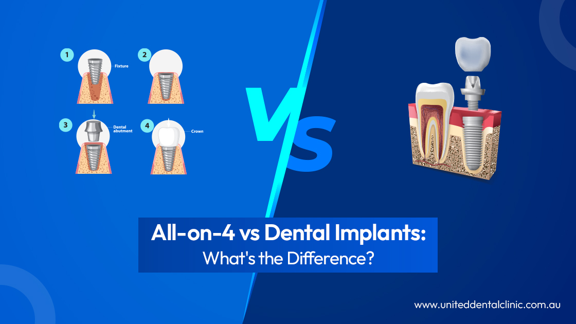 All-on-4 vs Dental Implants: What’s the Difference?