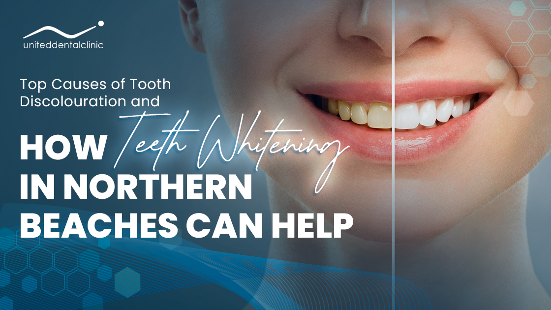 Top Causes of Tooth Discolouration and How Teeth Whitening in Northern Beaches Can Help